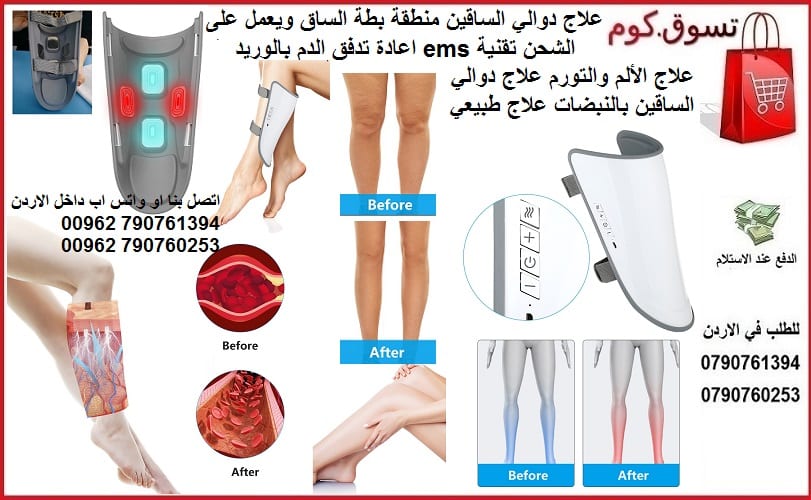 دوالي الساقين.. أعراض شائعة طرق للعلاج - علاج دوالي الساق منطقة بطة الساق ويعمل على الشحن تقنية ems اعادة تدفق الدم