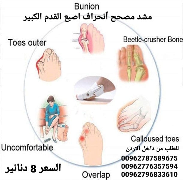 علاج اعوجاج إبهام القدم مشد طبي القدم علاج اصبع القدم . مصحح ٱنحراف اصبع القدم الكبير