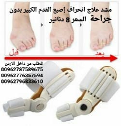 علاج انحراف إصبع القدم الكبير بدون جراحة علاج اعوجاج إبهام القدم مشد طبي